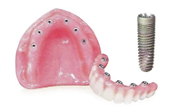 Fixed Implant Denture